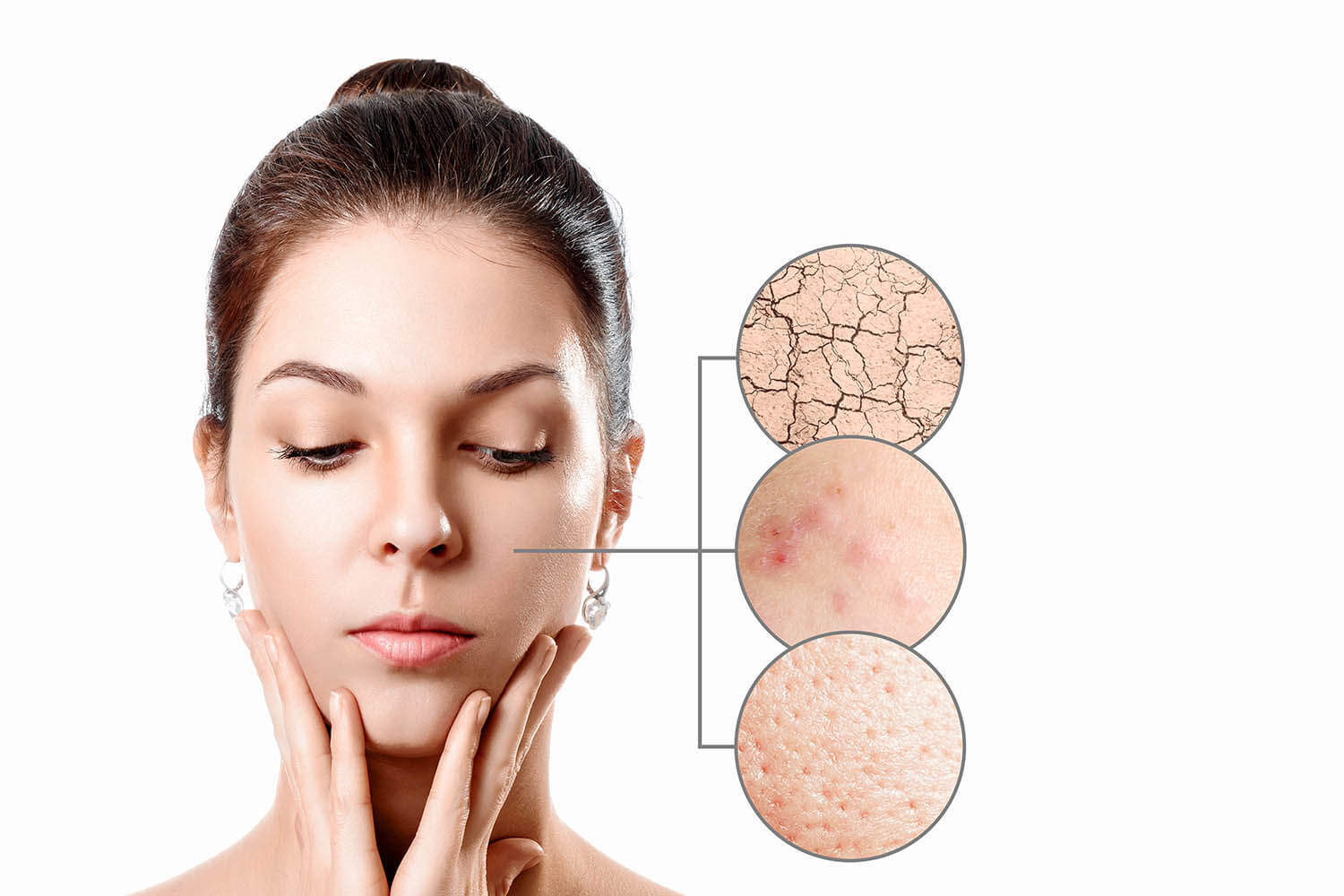 What Causes Acne on Forehead, Shoulders, Back, Neck, Chest
