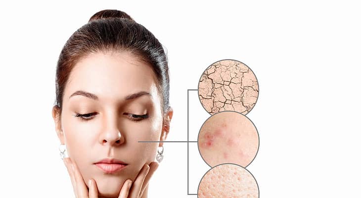 What Causes Acne on Forehead, Shoulders, Back, Neck, Chest